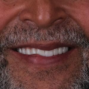 E-diş esenler,     Diş Tedavisi,Diş Estetiği,Diş Beyazlatma,     Ağız ve Diş Sağlığı,     Diş İmplantı,     Porselen Lamina,     Diş Protezi,     Çocuk Diş Hekimi,     Diş Ağrısı Tedavisi,     Gülüş Tasarımı,     Diş Temizliği,     Periodontal Tedavi,     Diş Eti Hastalıkları,     Diş Fırçalama Teknikleri,     Köprü Protez Tedavisi,     Kanal Tedavisi,     Diş Hekimi Randevusu,     Diş Beyazlatma Fiyatları,     Ağız Kokusu Nedenleri,     Diş Çürümesi Tedavisi,     Diş Hekimi İstanbul,     Diş Hekimi Danışmanlığı,     Ağız Hijyeni Önerileri