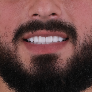 E-diş esenler,     Diş Tedavisi,Diş Estetiği,Diş Beyazlatma,     Ağız ve Diş Sağlığı,     Diş İmplantı,     Porselen Lamina,     Diş Protezi,     Çocuk Diş Hekimi,     Diş Ağrısı Tedavisi,     Gülüş Tasarımı,     Diş Temizliği,     Periodontal Tedavi,     Diş Eti Hastalıkları,     Diş Fırçalama Teknikleri,     Köprü Protez Tedavisi,     Kanal Tedavisi,     Diş Hekimi Randevusu,     Diş Beyazlatma Fiyatları,     Ağız Kokusu Nedenleri,     Diş Çürümesi Tedavisi,     Diş Hekimi İstanbul,     Diş Hekimi Danışmanlığı,     Ağız Hijyeni Önerileri