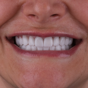 E-diş esenler,     Diş Tedavisi,Diş Estetiği,Diş Beyazlatma,     Ağız ve Diş Sağlığı,     Diş İmplantı,     Porselen Lamina,     Diş Protezi,     Çocuk Diş Hekimi,     Diş Ağrısı Tedavisi,     Gülüş Tasarımı,     Diş Temizliği,     Periodontal Tedavi,     Diş Eti Hastalıkları,     Diş Fırçalama Teknikleri,     Köprü Protez Tedavisi,     Kanal Tedavisi,     Diş Hekimi Randevusu,     Diş Beyazlatma Fiyatları,     Ağız Kokusu Nedenleri,     Diş Çürümesi Tedavisi,     Diş Hekimi İstanbul,     Diş Hekimi Danışmanlığı,     Ağız Hijyeni Önerileri