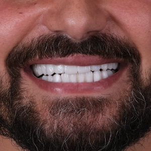 E-diş esenler,     Diş Tedavisi,Diş Estetiği,Diş Beyazlatma,     Ağız ve Diş Sağlığı,     Diş İmplantı,     Porselen Lamina,     Diş Protezi,     Çocuk Diş Hekimi,     Diş Ağrısı Tedavisi,     Gülüş Tasarımı,     Diş Temizliği,     Periodontal Tedavi,     Diş Eti Hastalıkları,     Diş Fırçalama Teknikleri,     Köprü Protez Tedavisi,     Kanal Tedavisi,     Diş Hekimi Randevusu,     Diş Beyazlatma Fiyatları,     Ağız Kokusu Nedenleri,     Diş Çürümesi Tedavisi,     Diş Hekimi İstanbul,     Diş Hekimi Danışmanlığı,     Ağız Hijyeni Önerileri